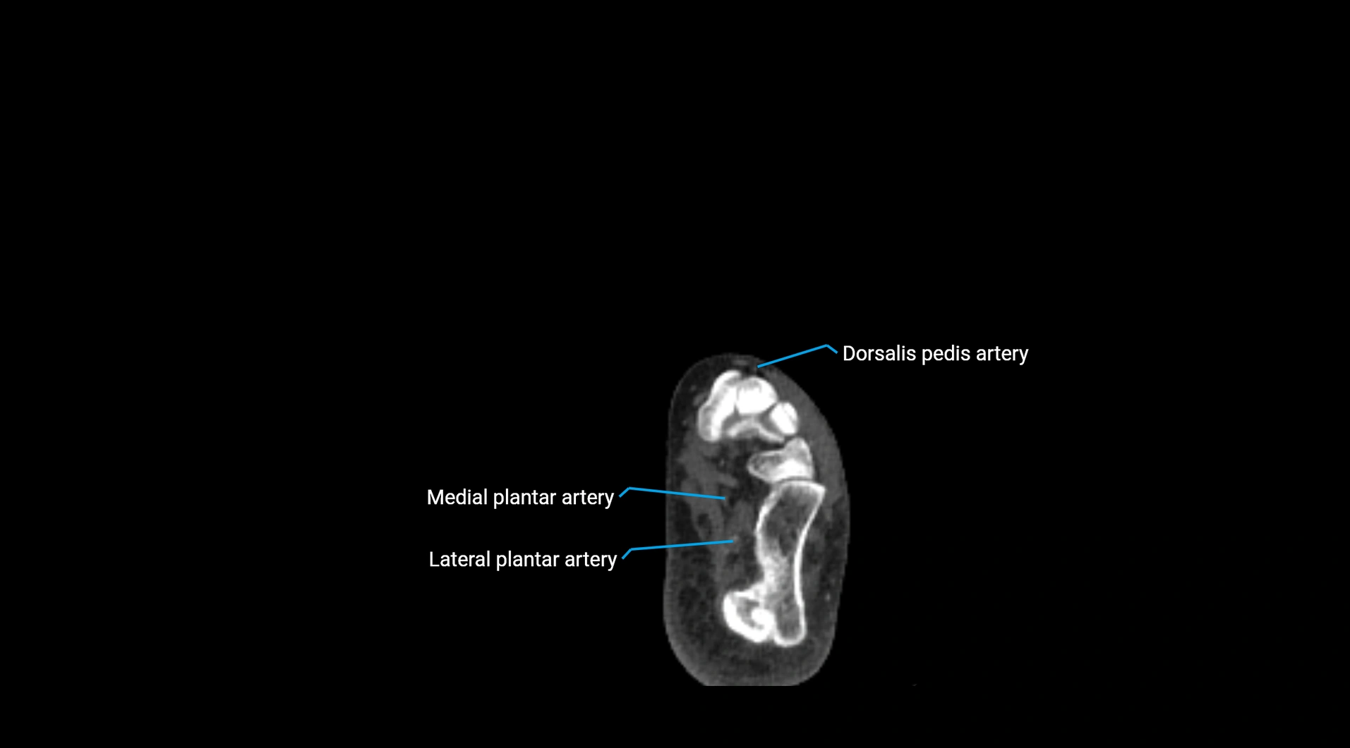 CTA lower limb cross sectional anatomy labelled image _286.webp